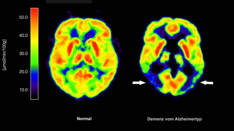 Demenzprävention: Wie Gesundheitsdaten Leben retten können